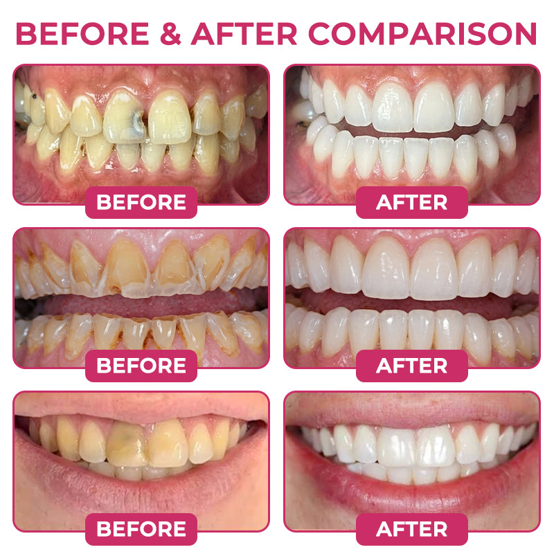 Healrize® DenPerm Cavity-Repair Natural Enamel Filling Gel👩‍🔬🦷4