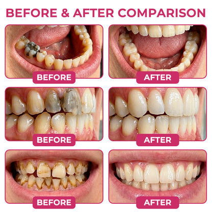 Healrize® DenPerm Cavity-Repair Natural Enamel Filling Gel👩‍🔬🦷4